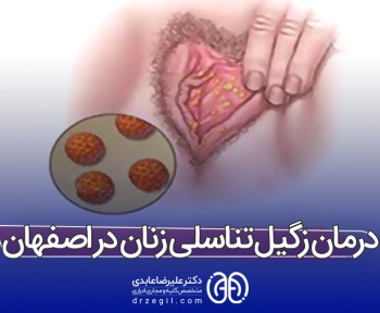 درمان زگیل تناسلی زنان در اصفهان