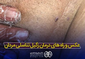 زگیل تناسلی مردان