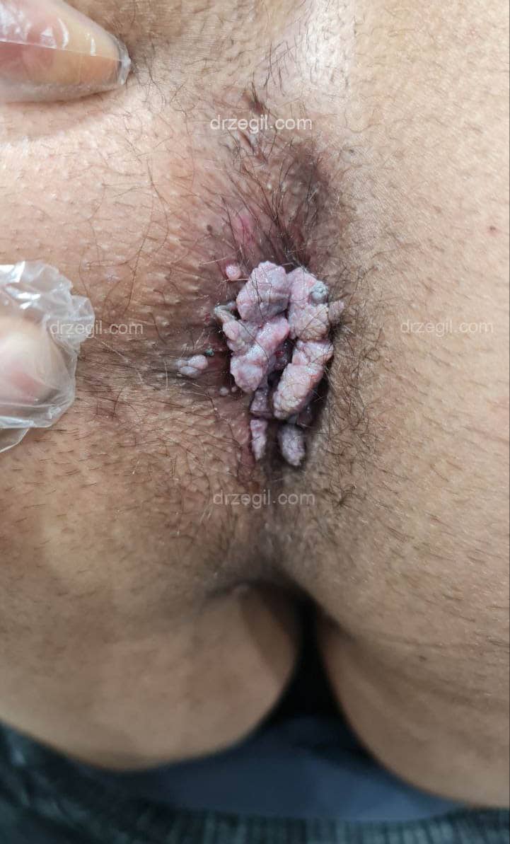 عکس زگیل تناسلی در داخل واژن